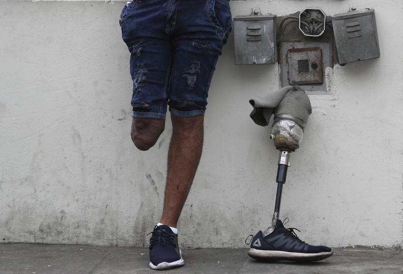 Artificial Limbs The World of Prosthetics Wisconsin Public Radio