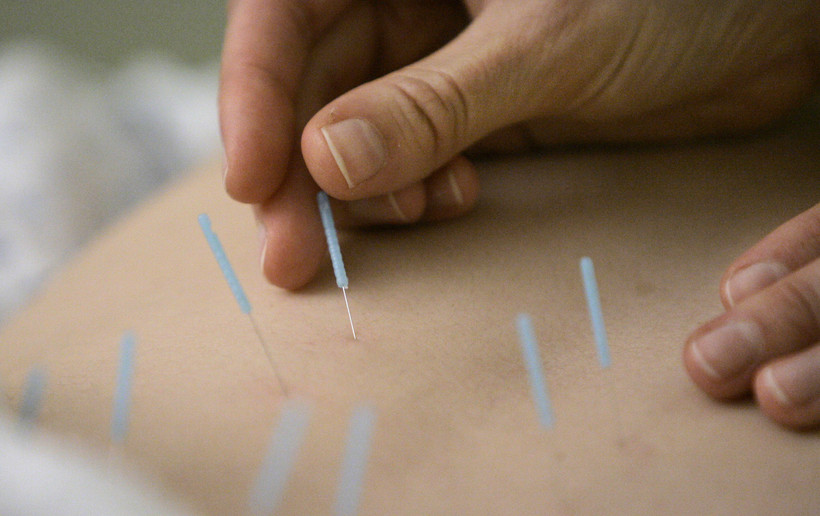 Acupuncture Isn't Just For Pain, Expert Says Wisconsin Public Radio